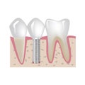Dental Implantation.